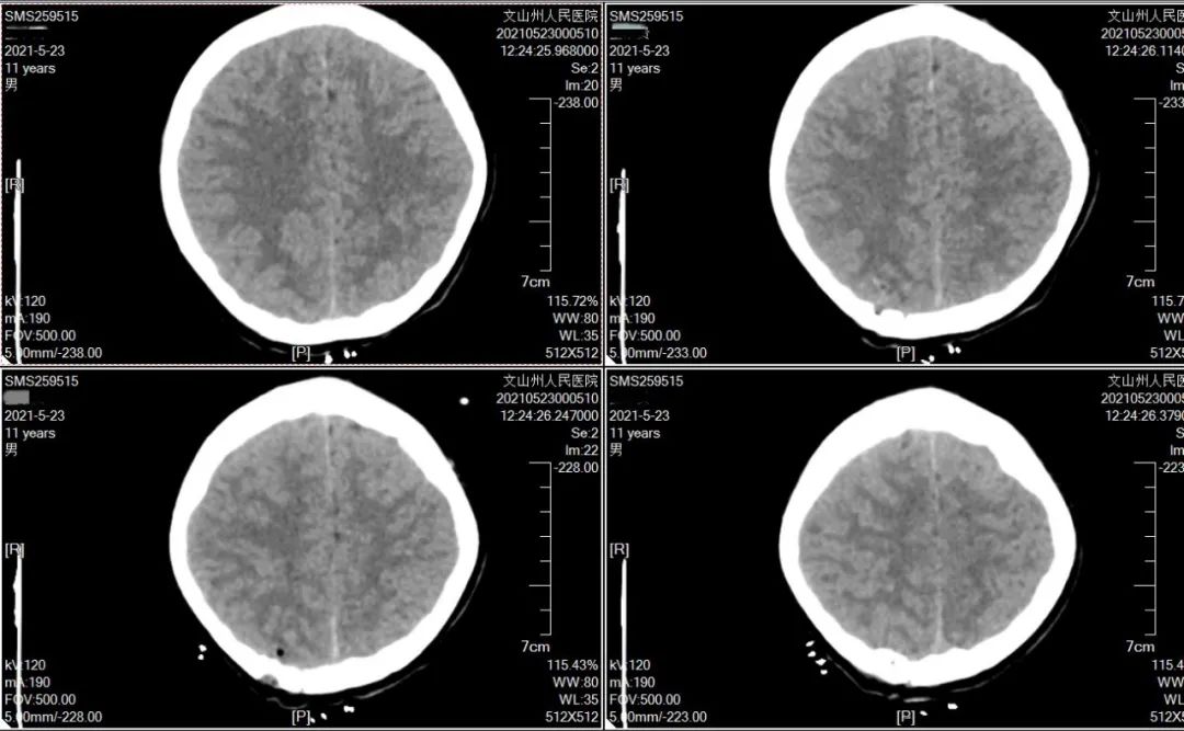放心了15厘米剪刀意外插入颅内的小男孩出院了